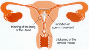 Mirena-In-Uterus