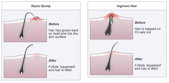 ingrownhair razor bump